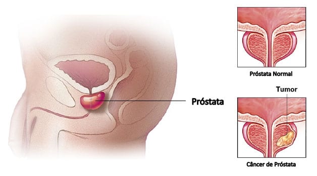 Inchaço na próstata não determina câncer